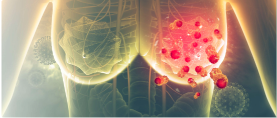Understanding early and metastatic breast cancers
